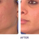 Laser Skin Resurfacing Treatment