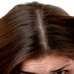 Dandruff Treatment