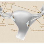 endometriosis