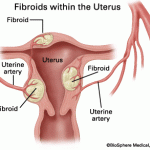 fibroid-tumors