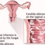 vaginal-yeast-infection