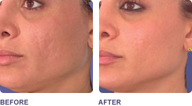 laser-skin-resurfacing