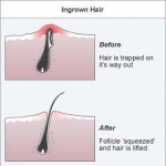prevention-ingrown-hair